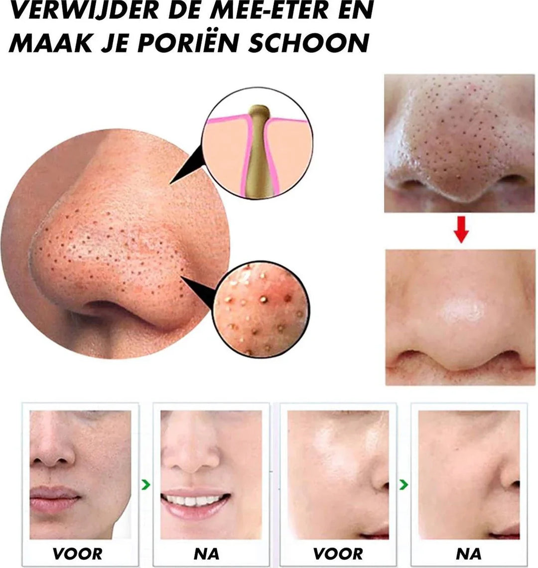 Lisslune | Electric Blackhead Remover
