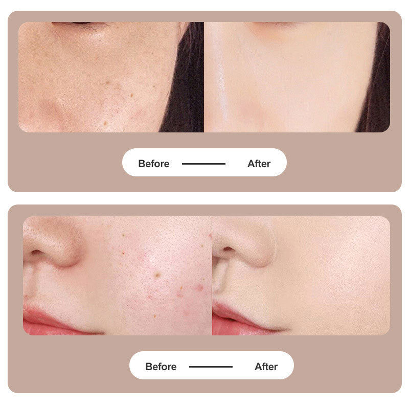 Lisslune | Plasma Pen Laser for Tattoo and Mole Removal