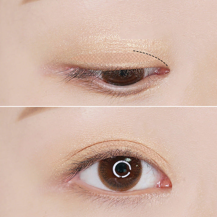 Lisslune | Eyelid Sagging Lids Stripes Sagging Lid Double Lids