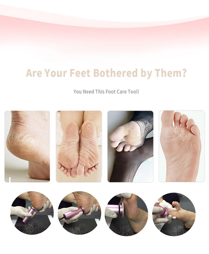 Lisslune | Callus Remover - Foot Callus Remover