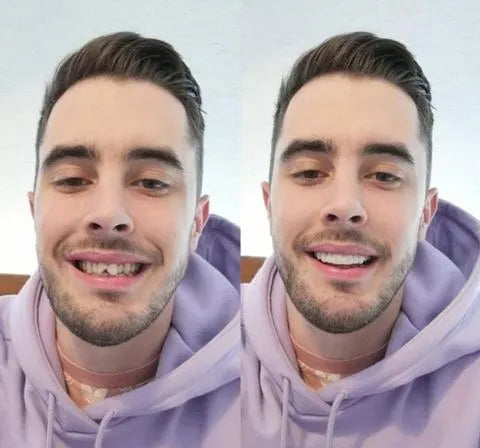 Lisslune | On Smile Veneers (Upper and Lower Jaw included)