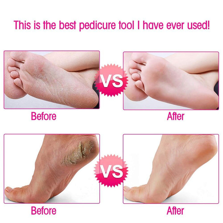 Lisslune | Callus Remover - Foot Callus Remover