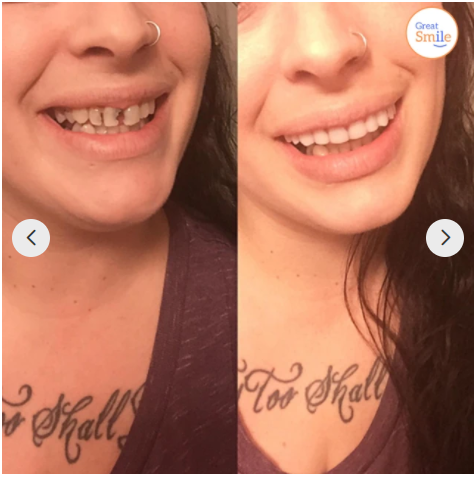 Lisslune |  - Snap-in Dental Prosthesis | 1+1 FREE!