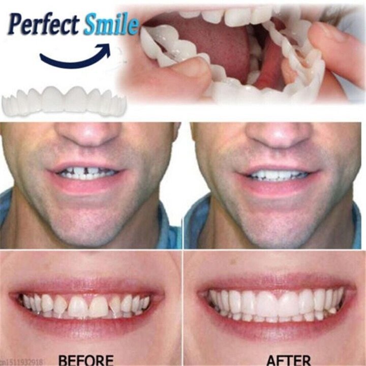 Lisslune | Adjustable Snap-On Dentures