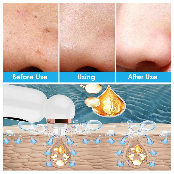 Lisslune | Blackhead Remover and Hydrodermabrasion Device