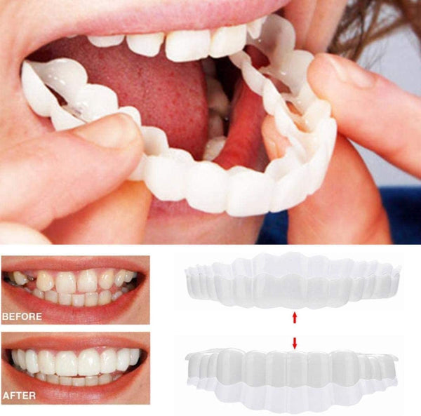 Lisslune | On Smile Veneers (Upper and Lower Jaw included)