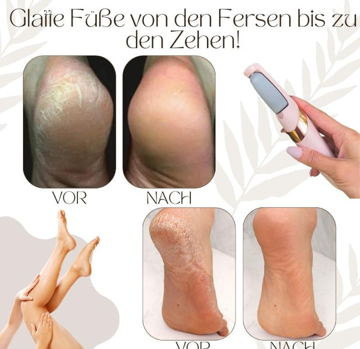 Lisslune | Callusos – Electric Callus Remover