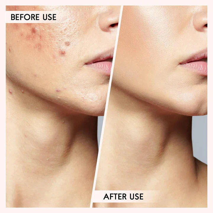 Lisslune | Blackhead and pimple removal set