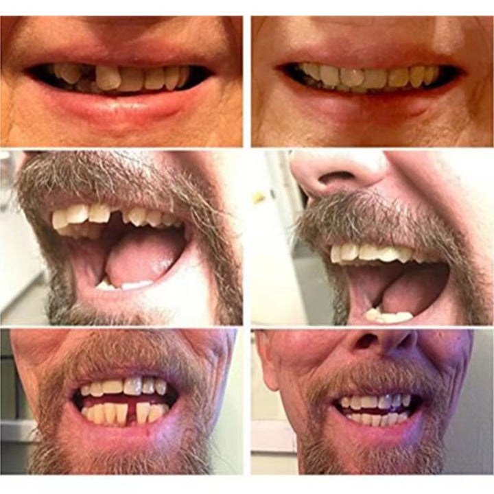 Lisslune | High-quality false teeth