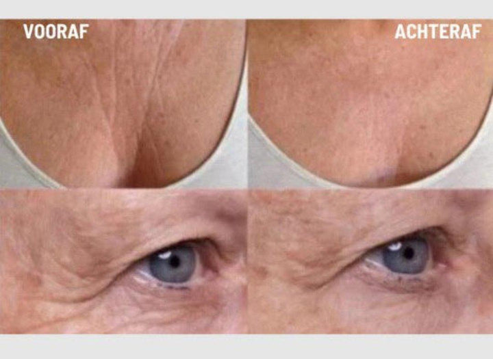 Lisslune | Anti-Wrinkle Silicone Pads