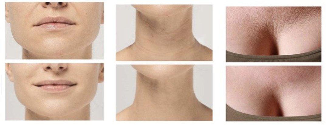 Lisslune | Anti-Wrinkle Silicone Pads
