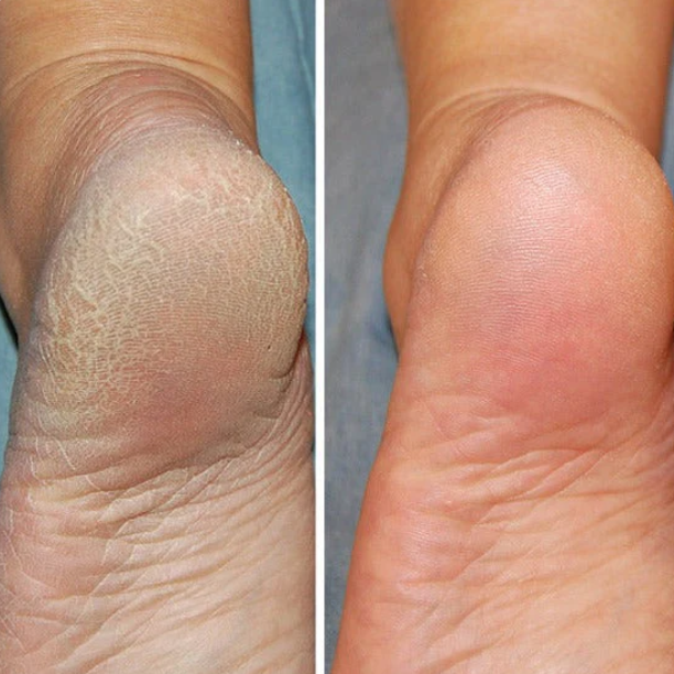 Lisslune | Silicon-Spa-Socks - Intensive care for cracked and tired feet