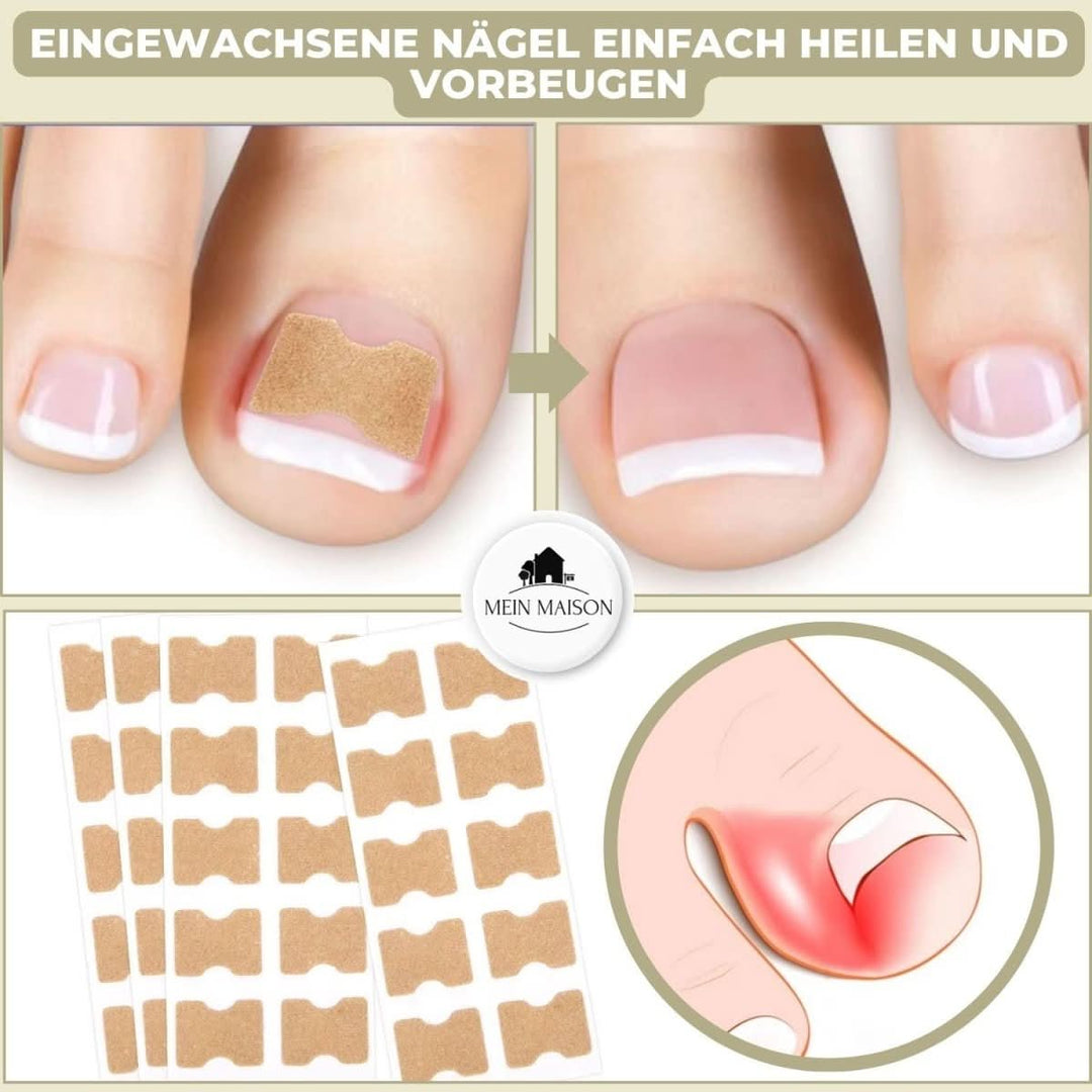 Lisslune | FixaNail – Painless nail correction for ingrown & deformed nails