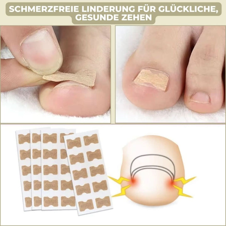 Lisslune | FixaNail – Painless nail correction for ingrown & deformed nails