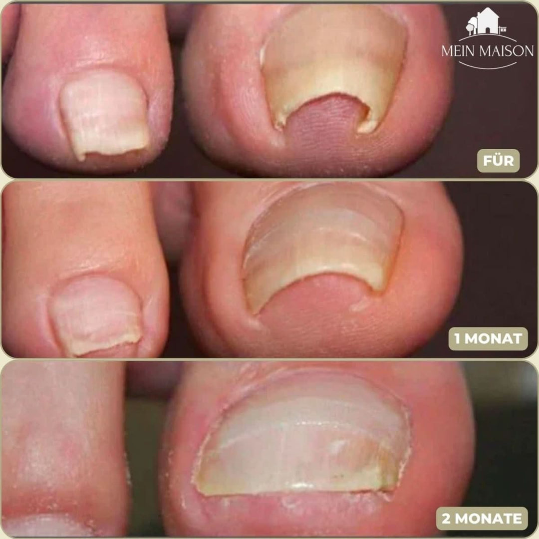 Lisslune | FixaNail – Painless nail correction for ingrown & deformed nails