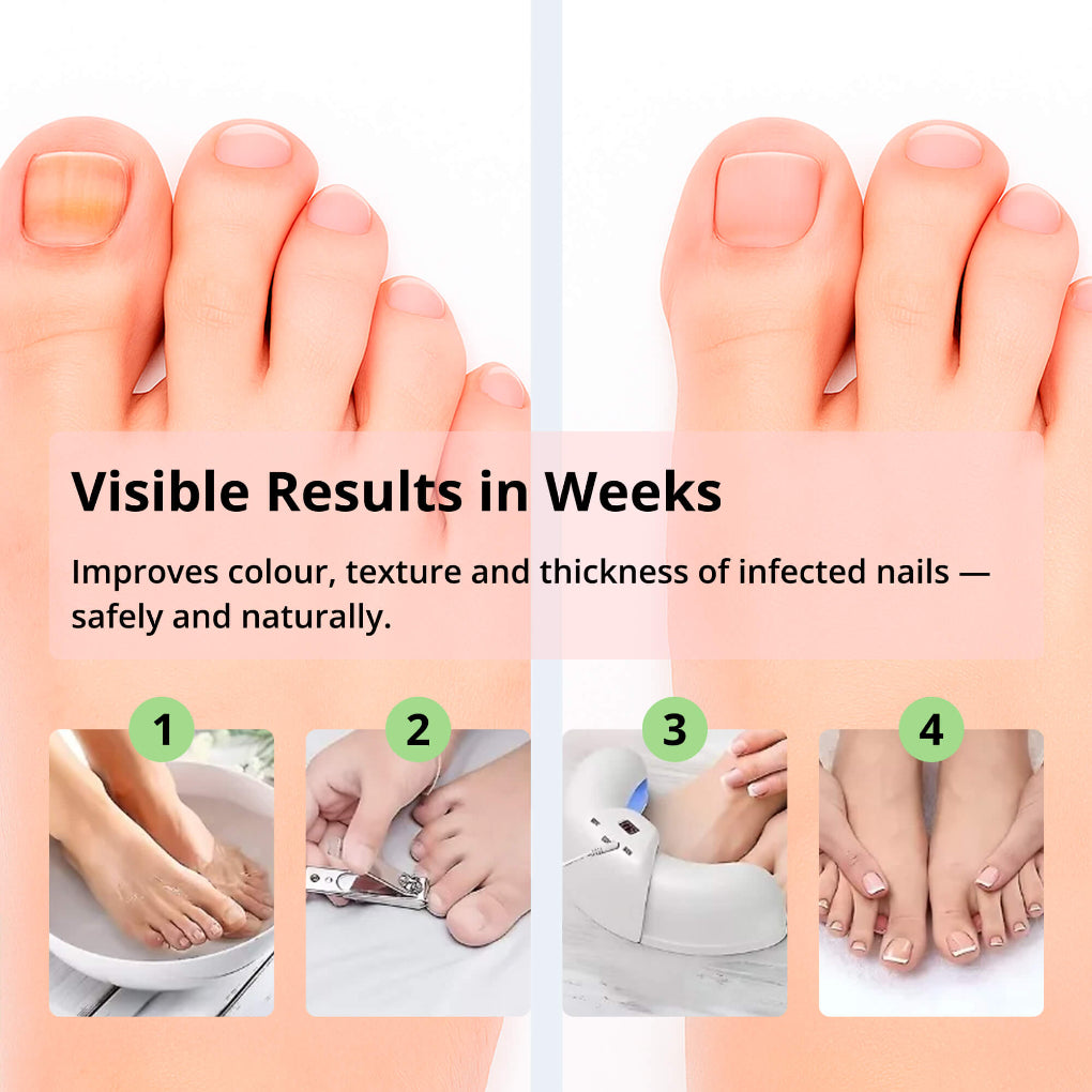 Lisslune | Laser Nail Treatment Device – Red and blue light against fungal nails
