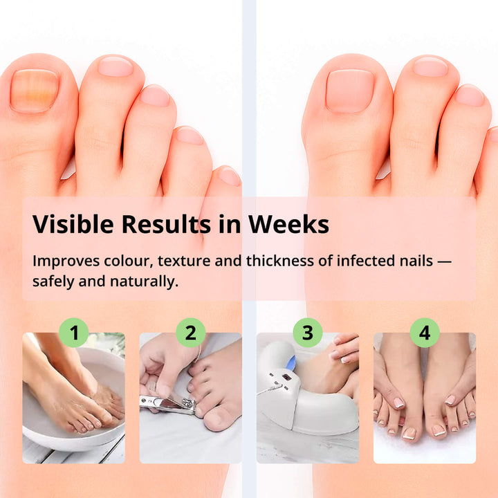 Lisslune | Laser Nail Treatment Device – Red and blue light against fungal nails