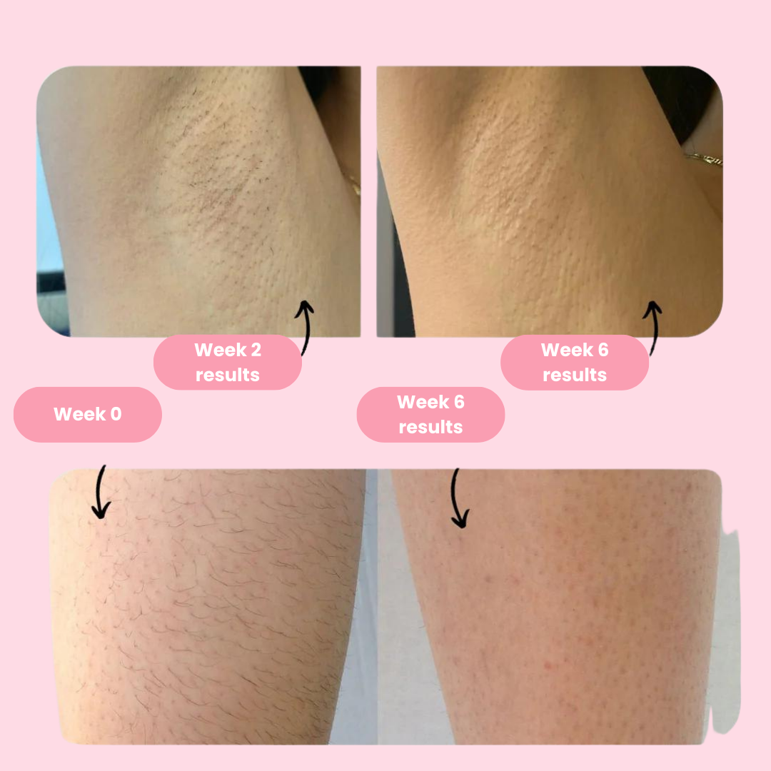 Lisslune | Royal IPL | Permanent Hair Removal