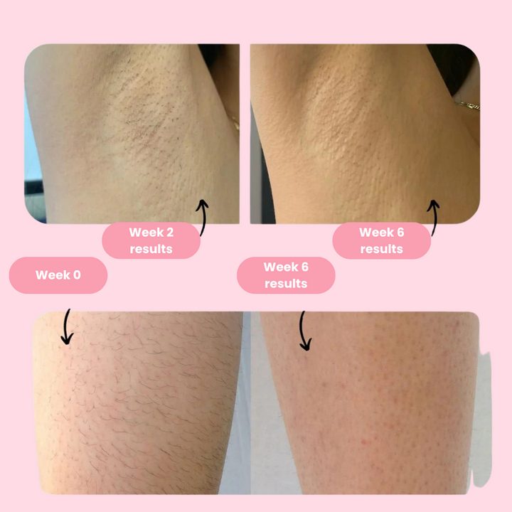 Lisslune | Royal IPL | Permanent Hair Removal