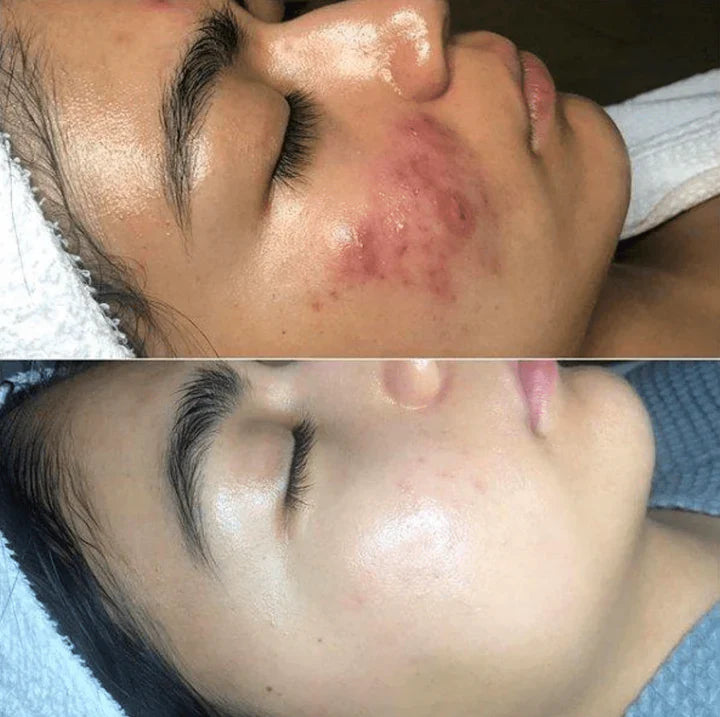 Lisslune | High-Frequency Skin Therapy Device