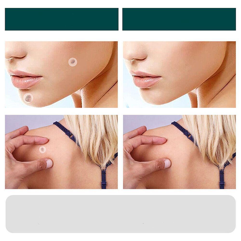 Lisslune | SkinClear - Plaster for the removal of spots and warts