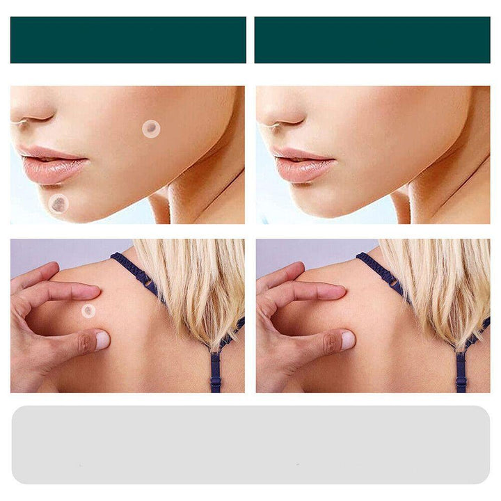 Lisslune | SkinClear - Plaster for the removal of spots and warts