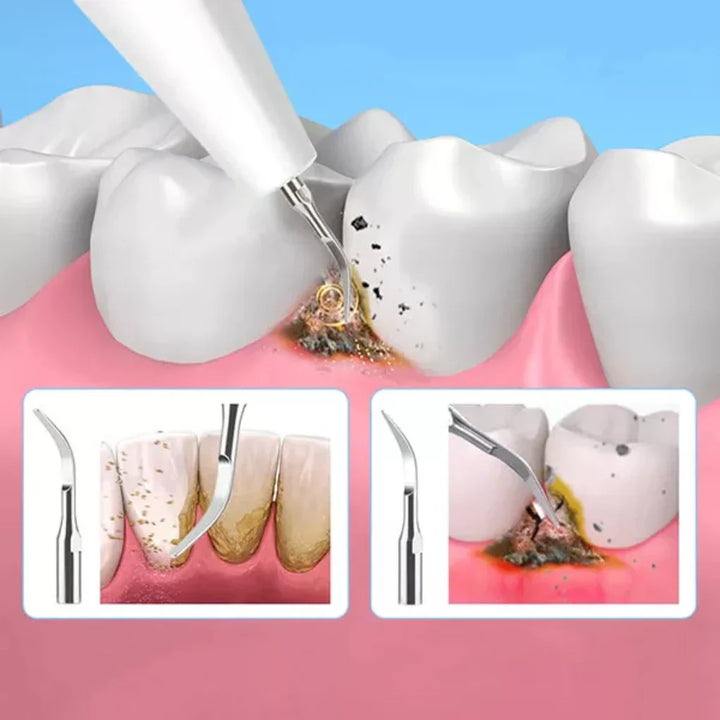 Lisslune | Ultrasonic Tooth Cleaning Pro – Electric Tartar Remover for Home Use