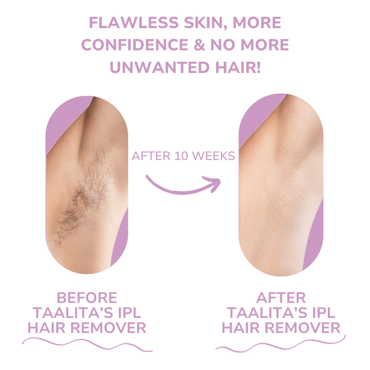 Lisslune | SoftLight IPL Hair Removal Device – Pain-Free Home Hair Removal