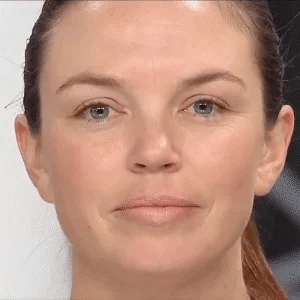 Lisslune | Eyelid Sagging Lids Stripes Sagging Lid Double Lids