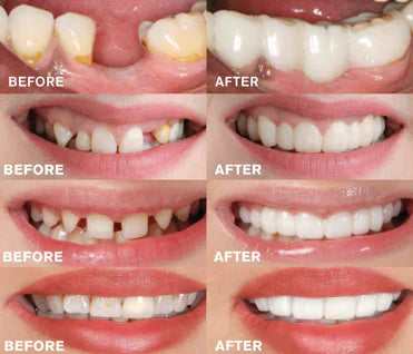 Lisslune | Click-In Dental Prosthesis | 1+1 FREE!