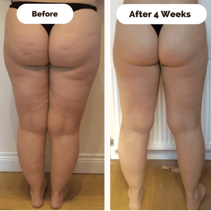 Lisslune | DERMAGLOW – Skin-Firming Massage Device for Cellulite