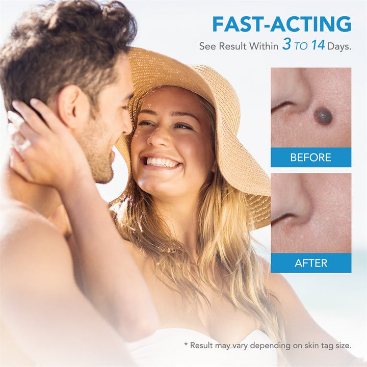 Lisslune | EPICLEAR – At-Home Skin Tag & Wart Remover Kit
