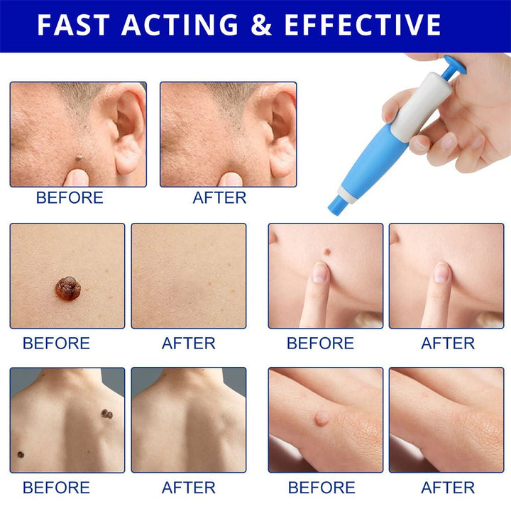 Lisslune | EPICLEAR – At-Home Skin Tag & Wart Remover Kit