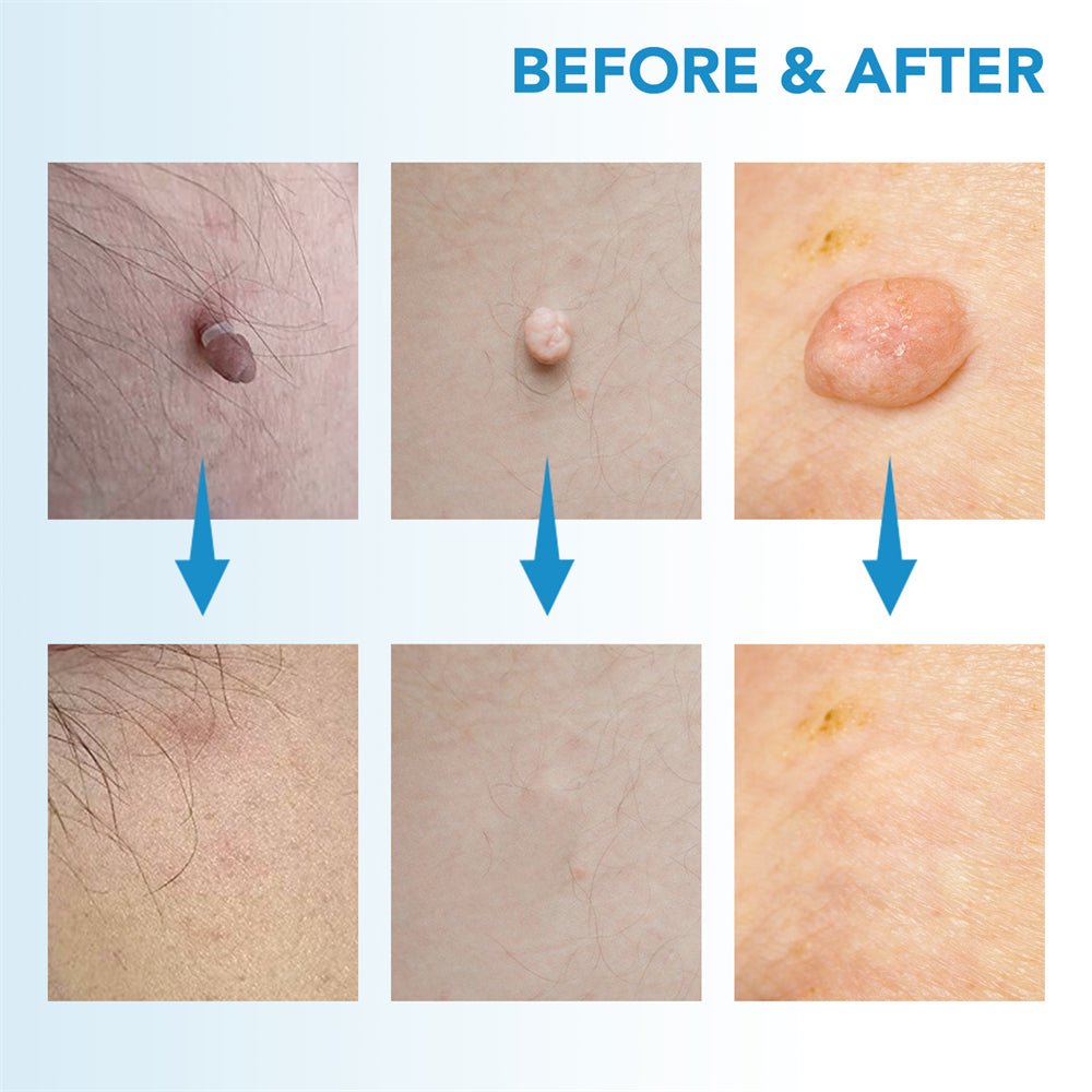 Lisslune | EPICLEAR – At-Home Skin Tag & Wart Remover Kit