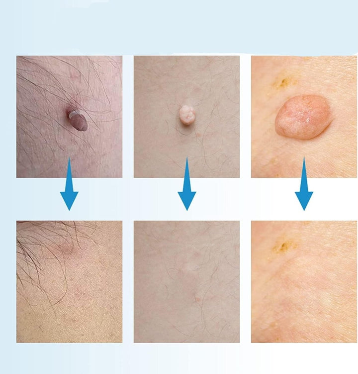 Lisslune | EPICLEAR – At-Home Skin Tag & Wart Remover Kit