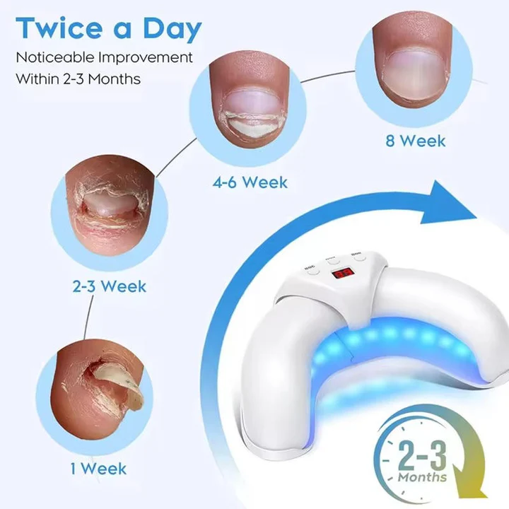 Lisslune | Nail Fungus Laser