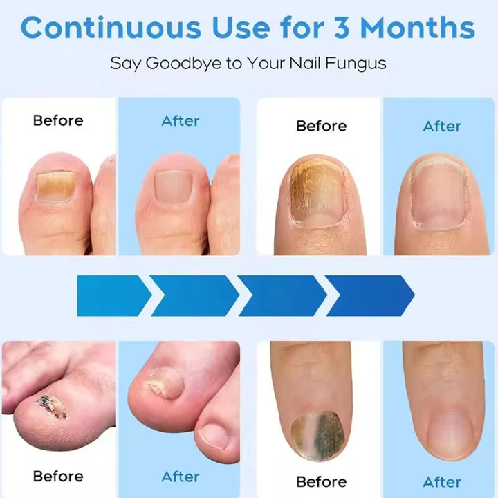 Lisslune | Nail Fungus Laser