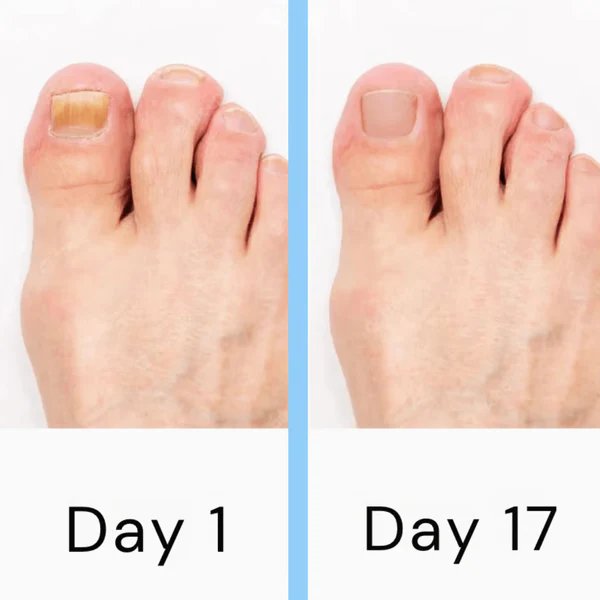 Lisslune | Nail Laser Fungus Device