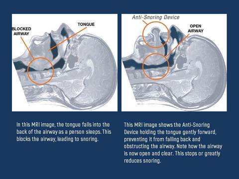 Lisslune | Apnea Tongue Stabilizing Device