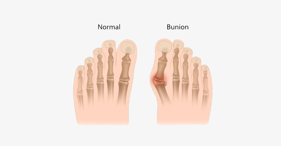 Lisslune | Comfort Healing Toe Separators and Hallux Valgus Spacers