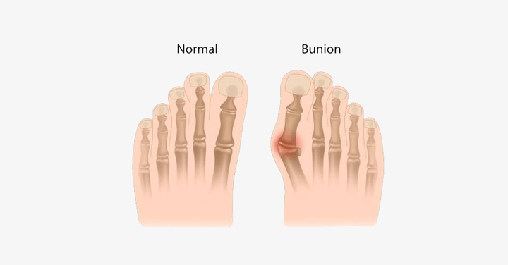 Lisslune | Comfort Healing Toe Separators and Hallux Valgus Spacers