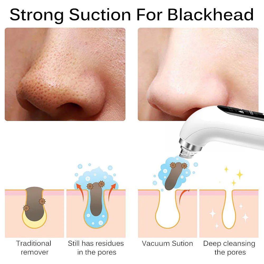 Lisslune | Professional Nose Blackhead Remover Vacuum - Deep Cleansing with Suction Technology