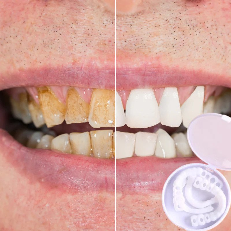 Lisslune | SmileSnap - Always the perfect smile with these veneers
