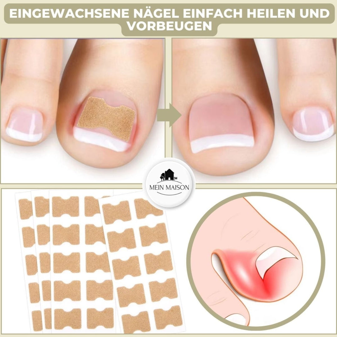 Lisslune | ALIGNSTRIP – Painless Nail Correction Strips for Ingrown & Deformed Nails