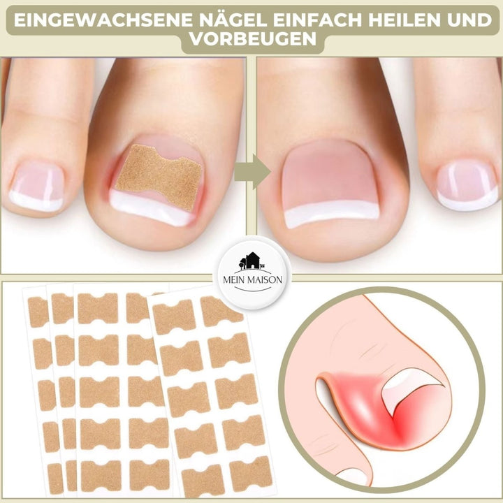 Lisslune | ALIGNSTRIP – Painless Nail Correction Strips for Ingrown & Deformed Nails