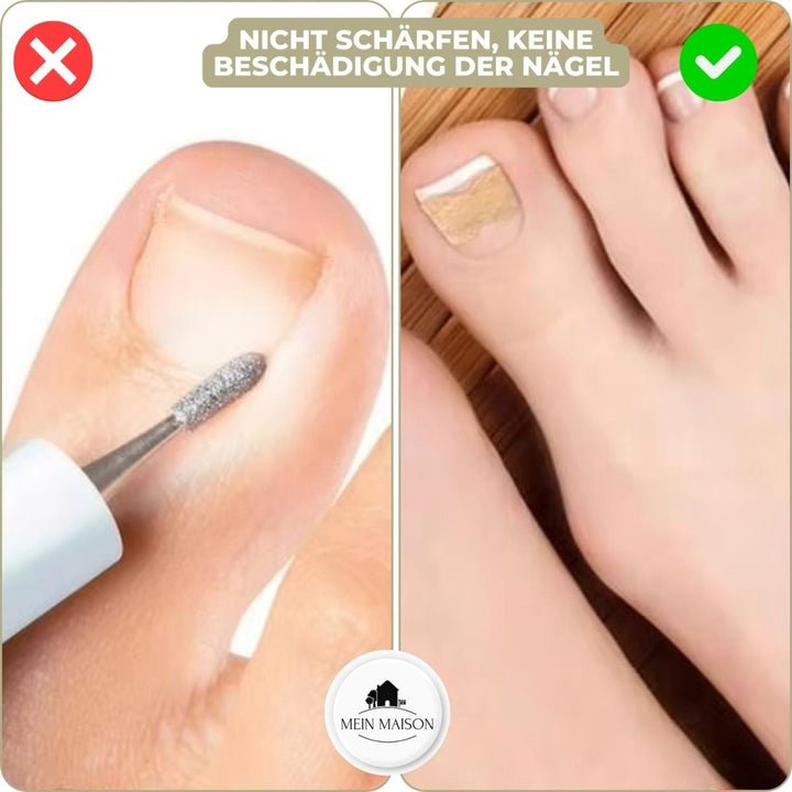 Lisslune | ALIGNSTRIP – Painless Nail Correction Strips for Ingrown & Deformed Nails