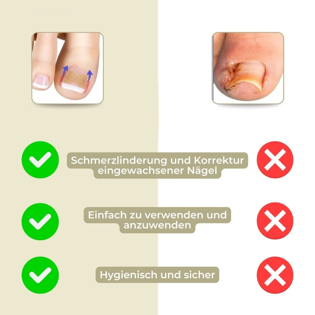 Lisslune | ALIGNSTRIP – Painless Nail Correction Strips for Ingrown & Deformed Nails