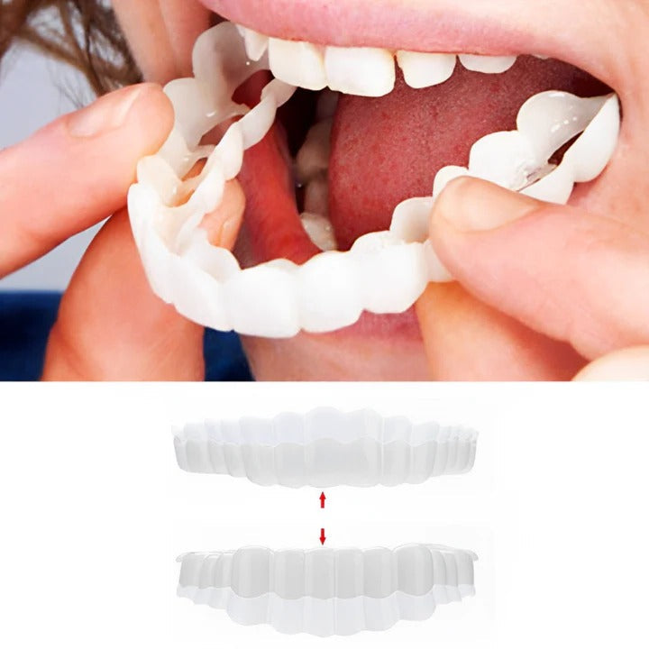 Lisslune | Removable Smile Veneers for Upper and Lower Teeth