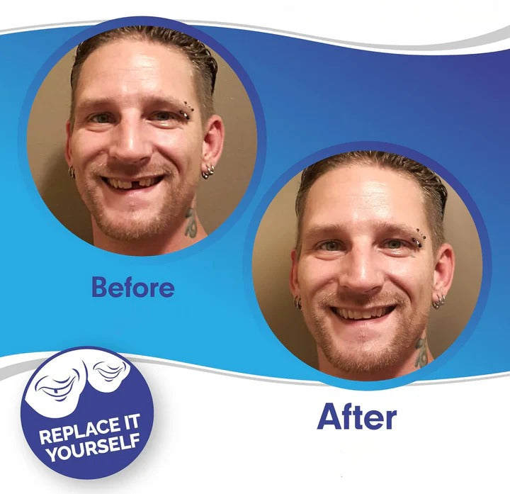 Lisslune | Removable Smile Veneers for Upper and Lower Teeth