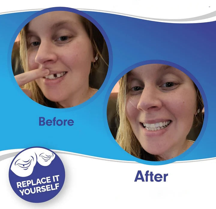 Lisslune | Removable Smile Veneers for Upper and Lower Teeth